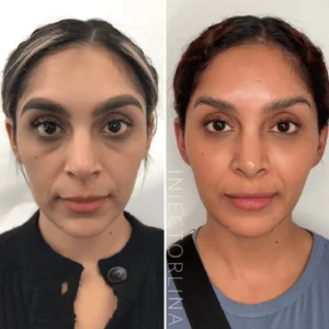 PRF Before and after by Artmedica Aesthetics