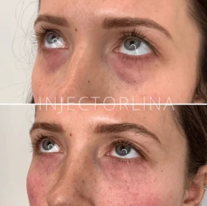 PRF Before and after by Artmedica Aesthetics