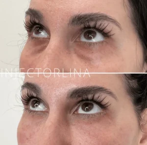 PRF EZ GEL With Women's Eyes Before and after Result by Artmedica Aesthetics