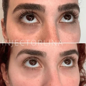 PRF EZ GEL Before and after Result by Artmedica Aesthetics