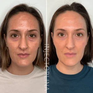 PRF EZ GEL Before and after Result by Artmedica Aesthetics