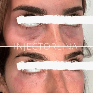 prf EZ gel before and after by Artmedica Aesthetics