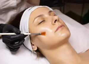 Chemical peel treatment for acne scars and pigmentation